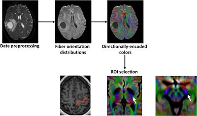 Constrained-Spherical Deconvolution Tractography in the Evaluation of the Corticospinal Tract in <mark class="highlighted">Glioma Surgery</mark>